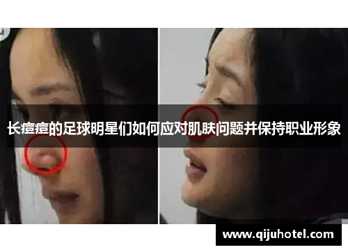 长痘痘的足球明星们如何应对肌肤问题并保持职业形象